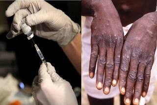 Monkeypox: घबराएं नहीं, जल्द आ रही है मंकीपॉक्स की वैक्सीन, वायरस के लक्षण-उपचार-बचाव के बारे में जानिए सबकुछ