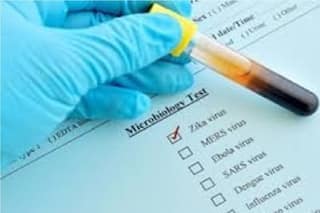 वैज्ञानिकों ने बनाया स्मार्टफोन क्लिप ऑन, जीका वायरस लगाएगा पता, SMS के जरिये आएगी रिपोर्ट