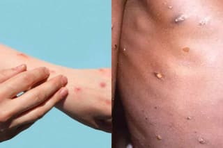 आठ साल या उससे कम उम्र के बच्चों में मंकीपॉक्स का खतरा अधिक- रिसर्चर्स का दावा