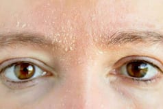 Eyebrow Dandruff is a Real Thing! Know How it Occurs And Ways to Treat it Quickly