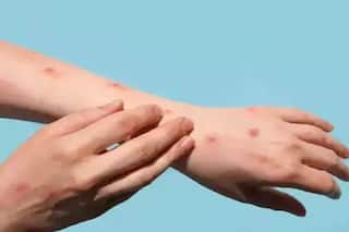 Global Monkeypox Cases Cross 70,000: WHO Prepares For    Most Dangerous    Phase, Urges All To Follow Guidelines