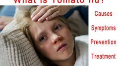 Tomato Flu: जानिए टोमाटो फ्लू क्या है, इसके लक्षण, कारण, बचाव और इलाज