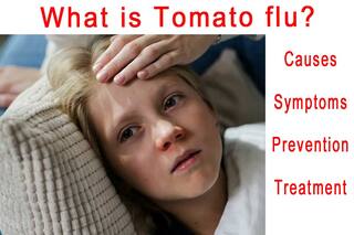 Tomato Flu: जानिए टोमाटो फ्लू क्या है, इसके लक्षण, कारण, बचाव और इलाज