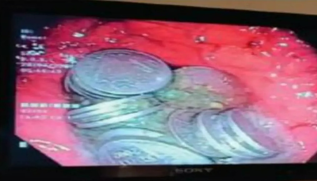 36-Year-Old Jodhpur Man Swallows 63 Coins of Rs 1, Doctors Remove It in 2-Day-Long Operation