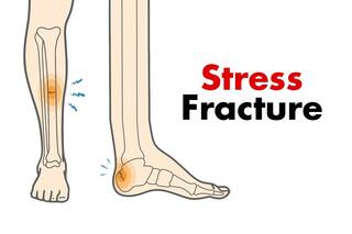 Stress Fracture News in Hindi, Latest Stress Fracture News | India.Com News