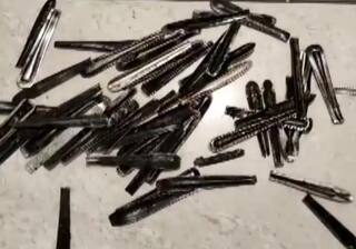 Doctors Remove 62 Steel Spoons From Man's Stomach, He Had Been Eating Them For a Year