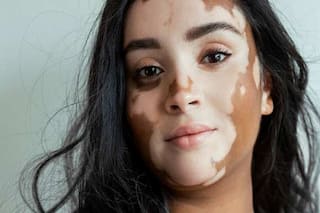 White spots on the skin: सफेद दाग किस विटामिन की कमी से होता है? जानें सफेद दाग के शुरुआती लक्षण