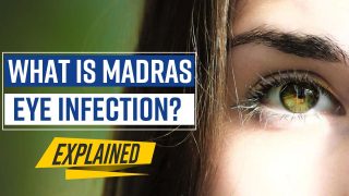 Madras Eye Cases Rise In Tamil Nadu, Here's What The Infection Is, It's Causes, Symptoms And Treatment Explained - Watch