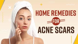 Skincare Tips: Struggling With Acne Scars? Try These Effective Home Remedies For Best Results- Watch Video