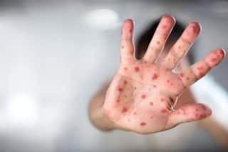 Unnao Family Loses 3 Children To Measles In 3 Weeks; 35 More Kids Of Same Village Infected