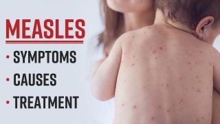 Measles Outbreak In Mumbai ! What Is It, Symptoms, Causes And Treatment, All You Need To Know About Measles - Watch Video