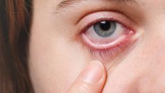Pink Eye Symptoms : क्या है पिंक आई की समस्या? जानिए इसके लक्षण और दूसरे व्यक्ति में फैलने का कारण