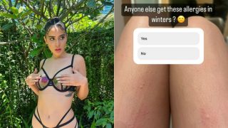 Urfi Javed Reveals Why She Likes Being Naked, Shares Pics of Skin Rashes And Allergies - Check Viral Post