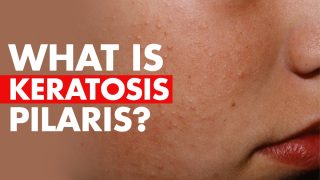 Chicken Skin is Actually a Serious Condition, Check Treatment of Keratosis Pilaris