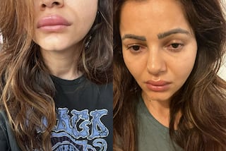 Rubina Dilaik Shares Pics of Her Swollen Face And Duck Lips, Fans Say 'We are Worried For You'