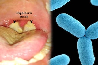 Diphtheria Outbreak: अफ्रीकी देश नाइजीरिया में डिप्थीरिया का प्रकोप, 200 से ज्यादा मामलों की पुष्टि, 40 की मौत