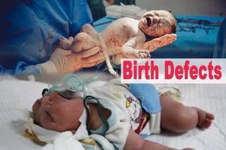 जन्मदोष क्या होते हैं? जन्मदोष को कैसे पहचानें और इसके मुख्य कारण