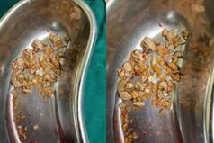 300 Kidney Stones Removed At Hyderabad's AINU From 75-Year-Old Patient