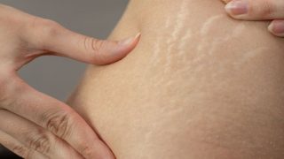 शरीर के स्ट्रेच मार्क्स को करें कम, इन तेलों की लें मदद