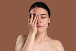 Anti-Acne Diet: 6 Expert-Recommended Foods to Help With Acne