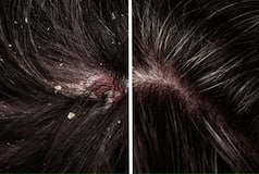 Monsoon Haircare: Shahnaz Husain Shares Effective Home Remedies to Get Rid of Monsoon Dandruff