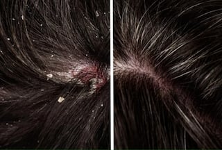 Monsoon Haircare: Shahnaz Husain Shares Effective Home Remedies to Get Rid of Monsoon Dandruff