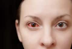 Eye Flu Cases on Rise: 5 Types of Conjunctivitis You Must Know About