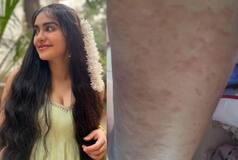 What Are Hives? A Horrible Rash That Lead to Actress Adah Sharma's Hospitalisation