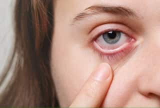 Conjunctivitis: 5 Tips to Quickly Recover From Eye Flu