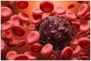 ब्लड कैंसर का मतलब सिर्फ ल्यूकेमिया नहीं, ये कैंसर भी हैं घातक