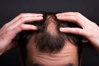 Diabetes And Hair Loss: How High Glucose Level Can Affect Your Hair?
