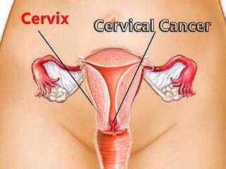 Bharat में हर साल 77 हजार महिलाओं की जान ले रहा सर्वाइकल कैंसर, जानिए शुरुआती लक्षण और कारण