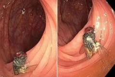 Doctors Find Fully Intact House Fly Inside Man's Intestines, He Went For Routine Check-Up
