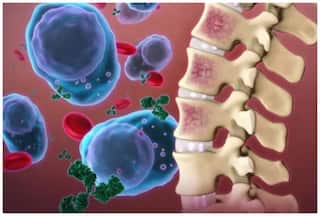 ब्लड कैंसर का ही प्रकार है मल्टीपल मायलोमा, जानें लक्षण, कारण और बचाव के तरीके