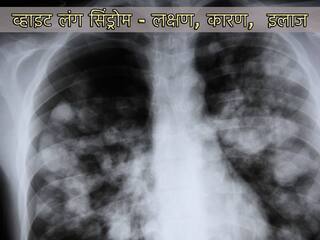 White Lung Syndrome क्या है, चीन में फैले निमोनिया के बीच जानिए व्हाइट लंग सिंड्रोम के लक्षण, कारण और इलाज