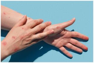 इज़राइल में तेजी से पैर पसार रहा है मंकीपॉक्स, जानें इसके कारण, लक्षण, बचाव के उपाय