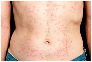 स्किन पर पड़ने वाले ये रैशेज हो सकते हैं खतरनाक, पूरे शरीर में फैल सकता है इंफेक्शन