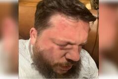 Putin's Critic Navalny's Former Chief Of Staff Leonid Volkov Attacked With Hammer in Lithuania