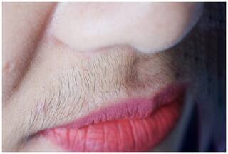 महिलाओं के चेहरे पर क्यों आने लगती है दाढ़ी-मूंछ? जानिए इसके पीछे के कुछ कारण