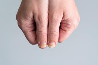 Calcium Deficiency in Women: Brittle Nails to Muscle Cramps, 5 Signs That Indicate Low Levels of Calcium in Body