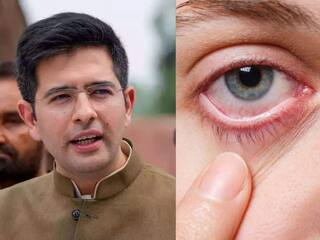 कहीं आप भी तो नहीं हैं Raghav Chadha जैसी बीमारी का शिकार? जान लें आंखों से जुड़े इन शुरुआती लक्षणों के बारे में