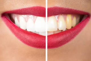 Oral Health: 5 Foods That Can Naturally Whiten Teeth And Brighten up Your Smile