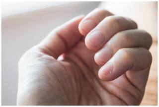 क्या सच में नाखूनों का बदलता रंग हो सकता है कैंसर का इशारा? डॉक्टर से जानें