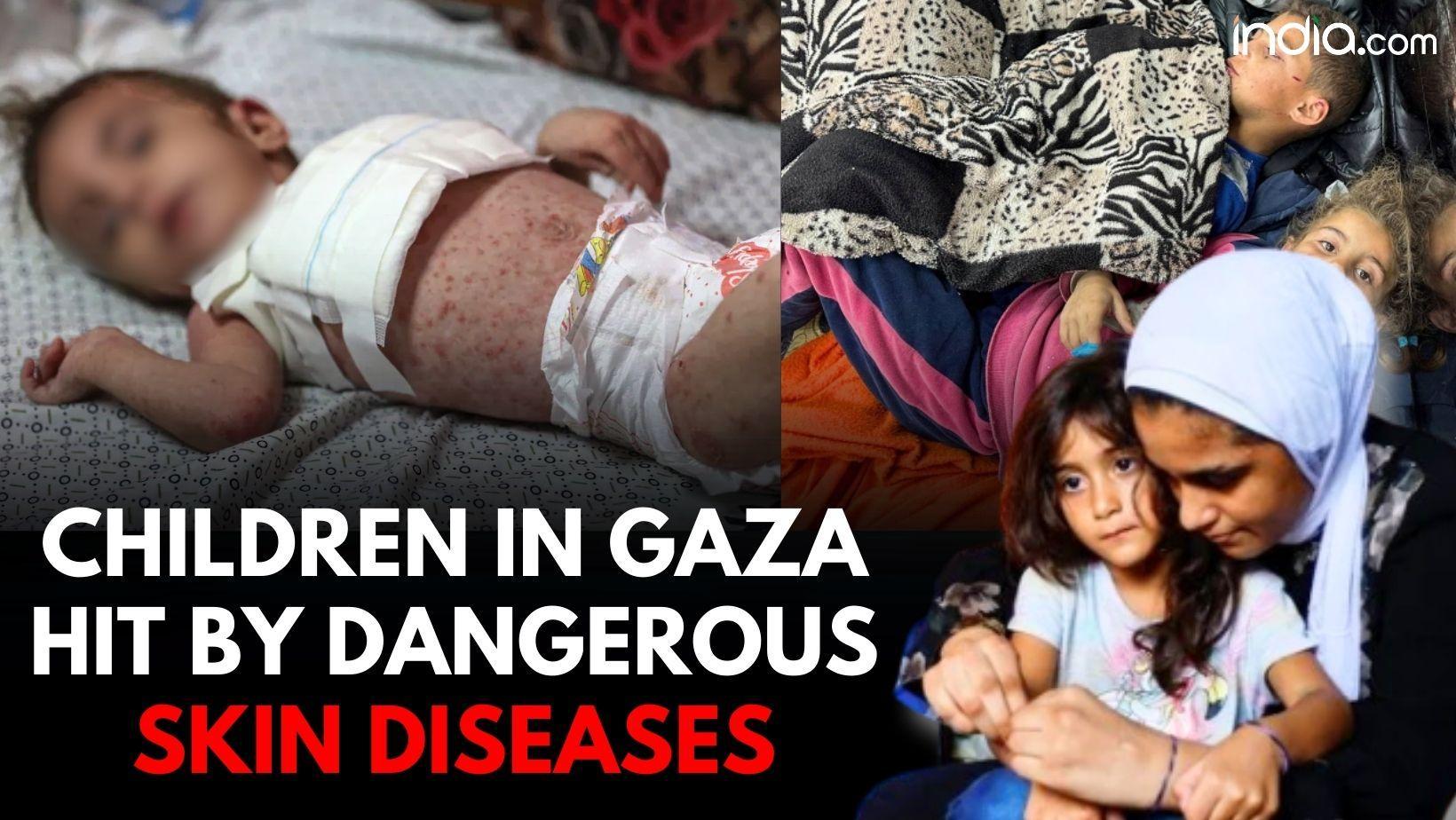 Israel- Hamas war: Dangerous skin diseases spreading among children in Gaza