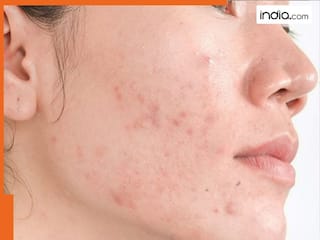क्या है Hyper Pigmentation? जो Skin को करता है डैमेज, जानें इसके कारण और बचाव के उपाय