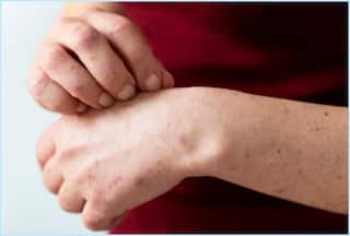 Mpox Health Emergency: Should India Be Worried? Mini Toolkit to Protect Yourself