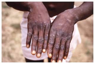 दबे पांव देश में पैर पसार रहा है मंकीपॉक्स, ये लक्षण दिखने पर तुरंत हो जाएं चौकन्ने