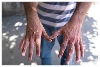 कहीं आप भी तो नहीं कर रहे हैं मंकीपॉक्स को चिकनपॉक्स समझने की भूल? डॉक्टर से जानें कैसे करें पहचान