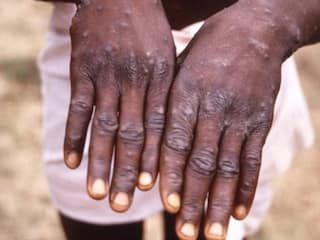 Mpox Virus : एमपॉक्स वायरस को लेकर सरकार अलर्ट, भारत में आने वाले विदेशी यात्रियों की होगी मेडिकल जांच