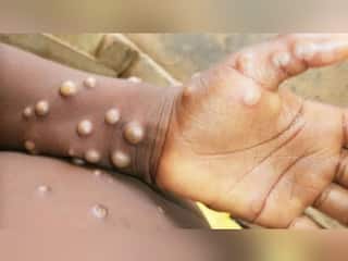 क्या कोरोना वायरस जितना ही खतरनाक और जानलेवा है Mpox Virus? WHO ने दिया सभी सवालों का जवाब